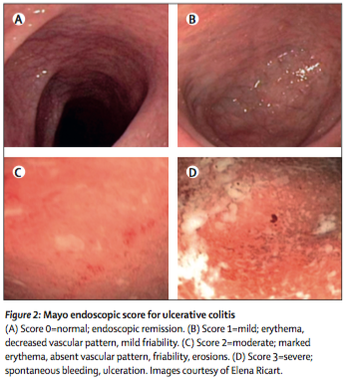 ulcerative colitis colonoscopy findings